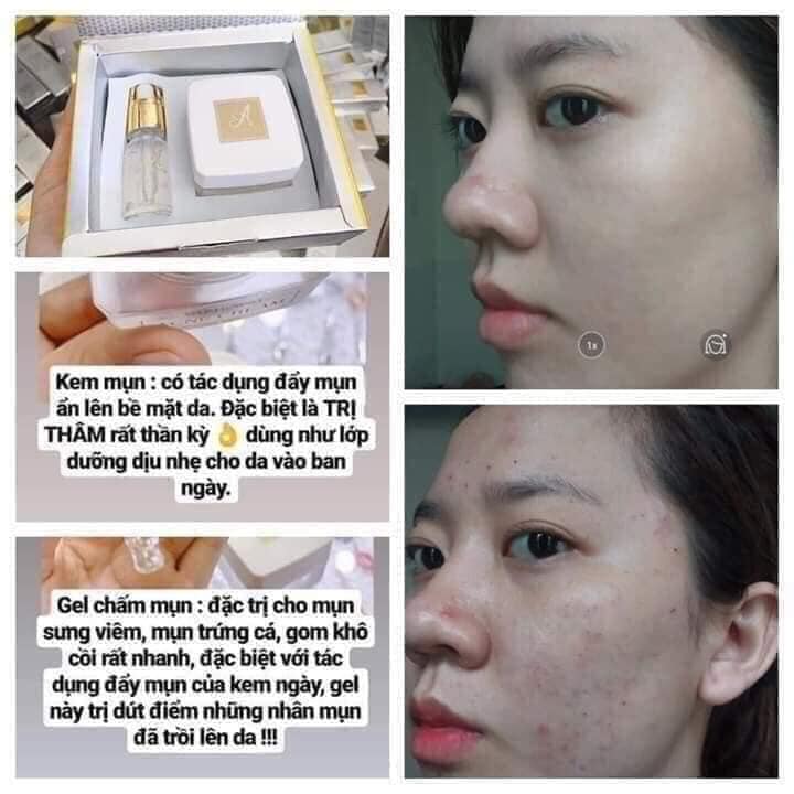 Kem trị mụn siệu tốc hiệu quả A Cosmetic