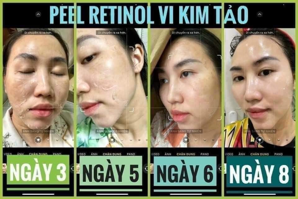 Peel da Retinol Vi tảo Trang Nemo