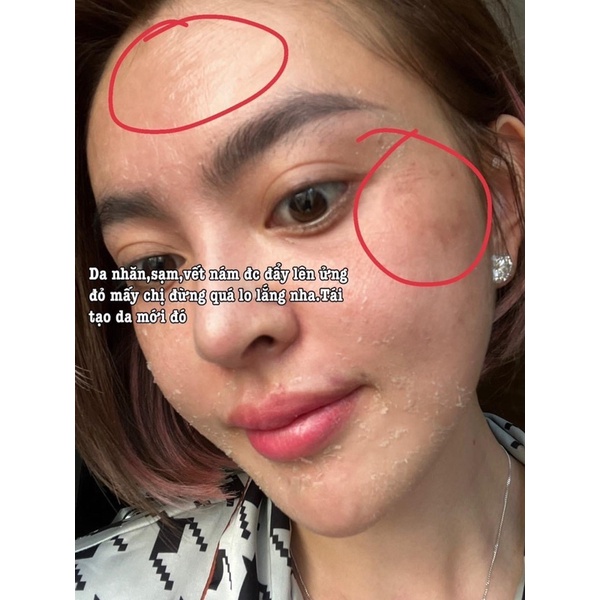 Peel da Retinol Vi tảo Trang Nemo